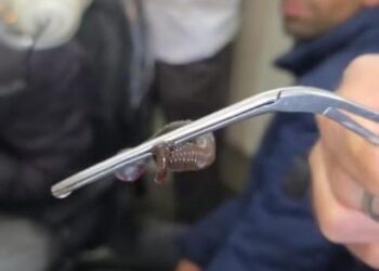Doctors Remove Snake-Like Worm From Nostril Of An Adolescent Boy In Anantnag