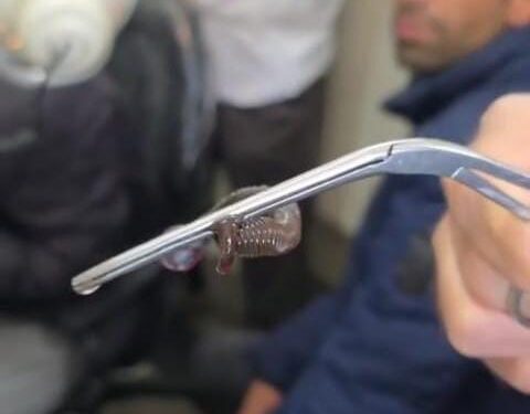Doctors Remove Snake-Like Worm From Nostril Of An Adolescent Boy In Anantnag